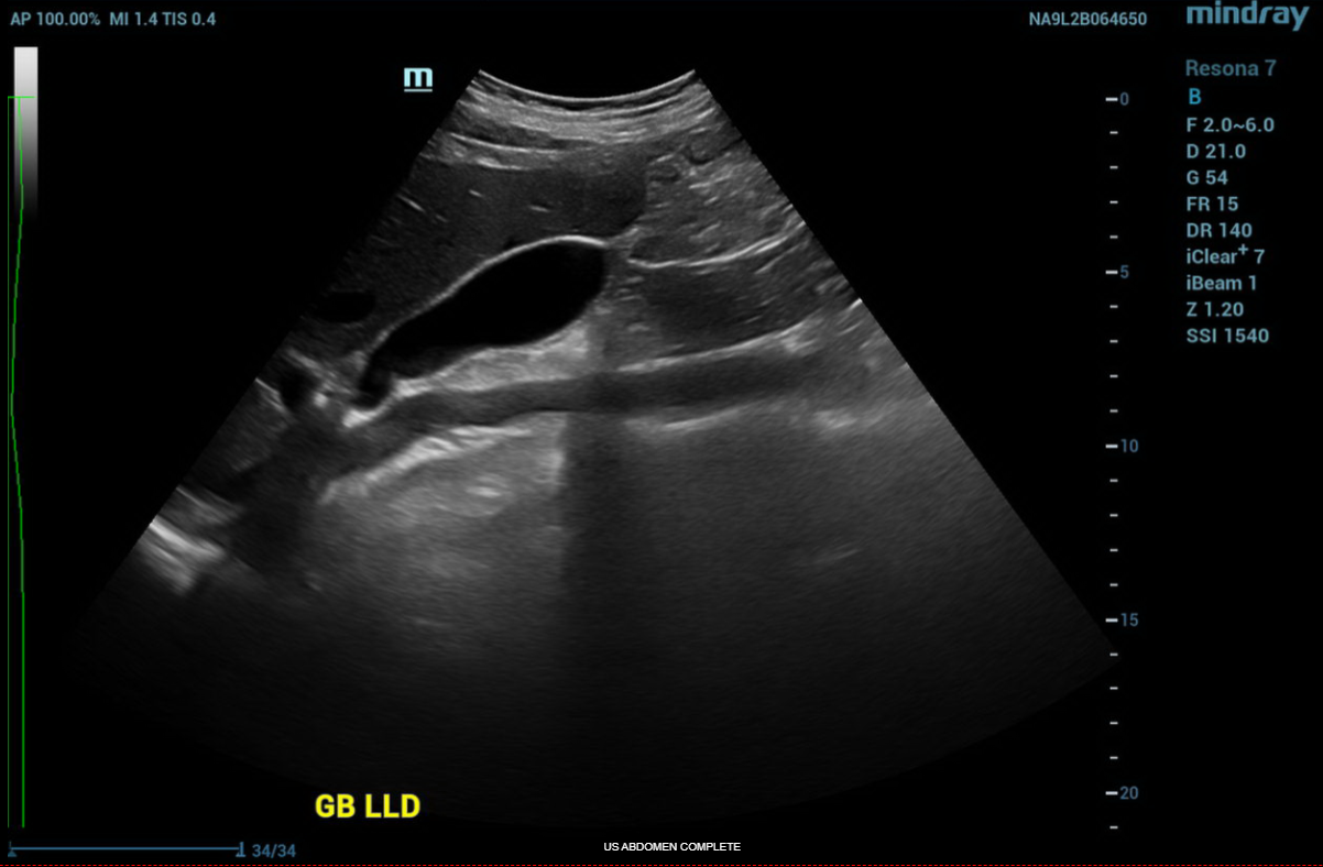 ULTRASOUND ABDOMEN GENERAL