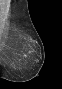 MRI BREASTS
