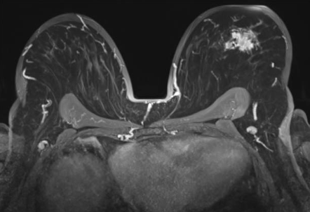 MRI BREASTS