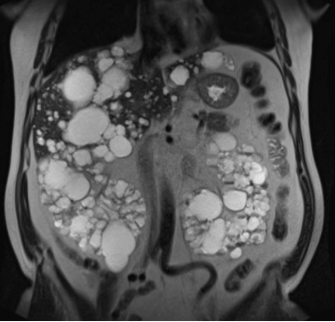 MRI FULL BODY HEAD/NECK/CHEST/ABDOMEN/PELVIS/SPINE