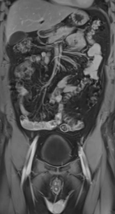MRI FULL BODY HEAD/NECK/CHEST/ABDOMEN/PELVIS/SPINE