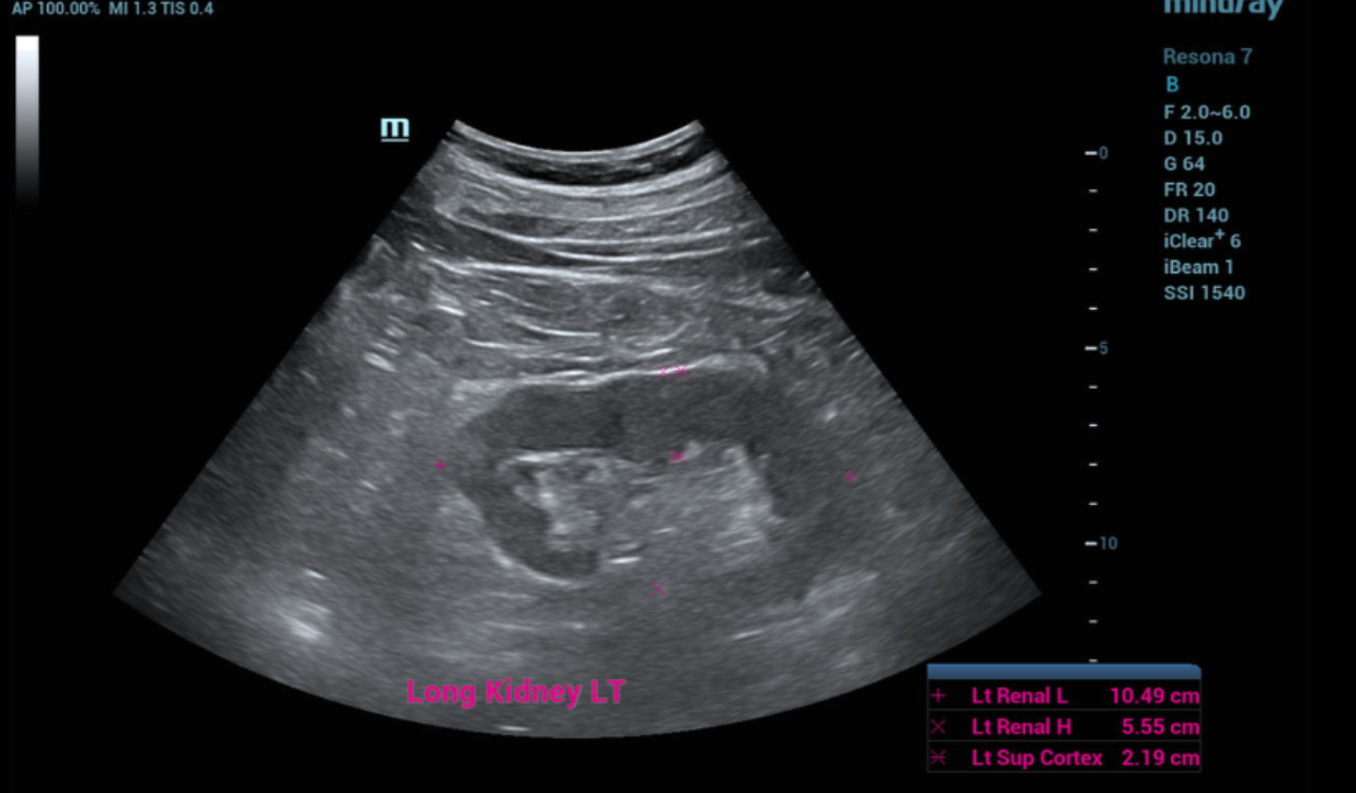 ULTRASOUND KIDNEYS