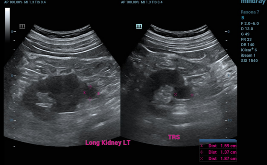 ULTRASOUND KIDNEYS