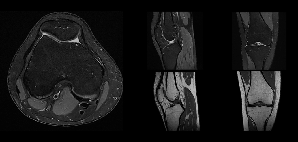 MRI KNEE