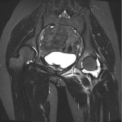MRI FEMUR