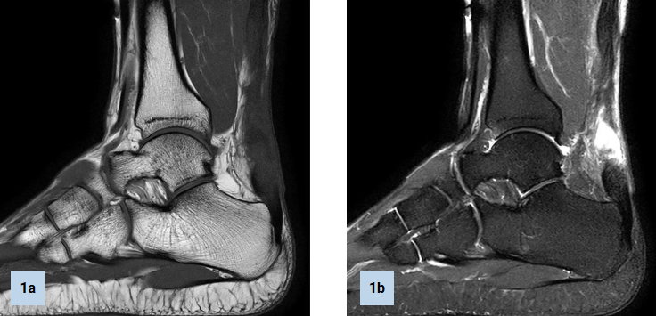 MRI ACHILLES TENDON