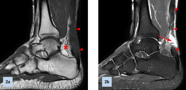MRI ACHILLES TENDON