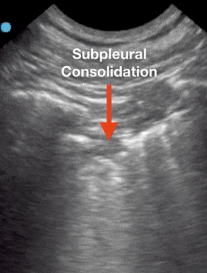 ULTRASOUND PLEURAL SPACE