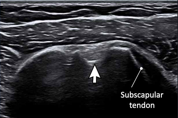 ULTRASOUND SHOULDER
