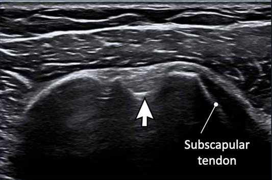 ULTRASOUND SHOULDER
