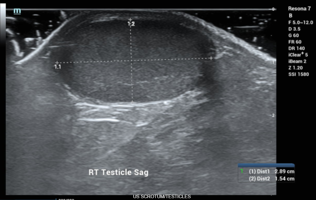 ULTRASOUND TESTICLES
