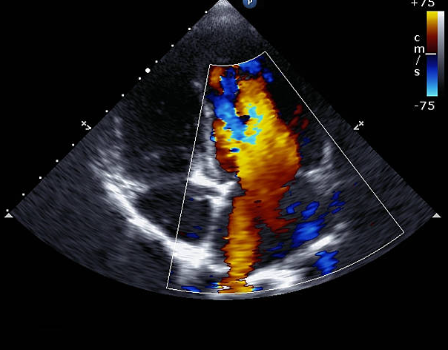 ULTRASOUND HEART ECHOCARDIOGRAM