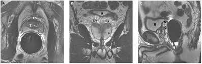 Prostate Magnetic Resonance Imaging (MRI)