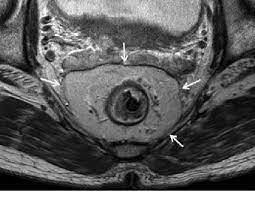 Rectum Magnetic Resonance Imaging (MRI)