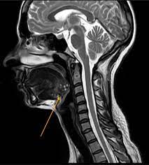 THYROID MAGNETIC RESONANCE IMAGING (MRI)