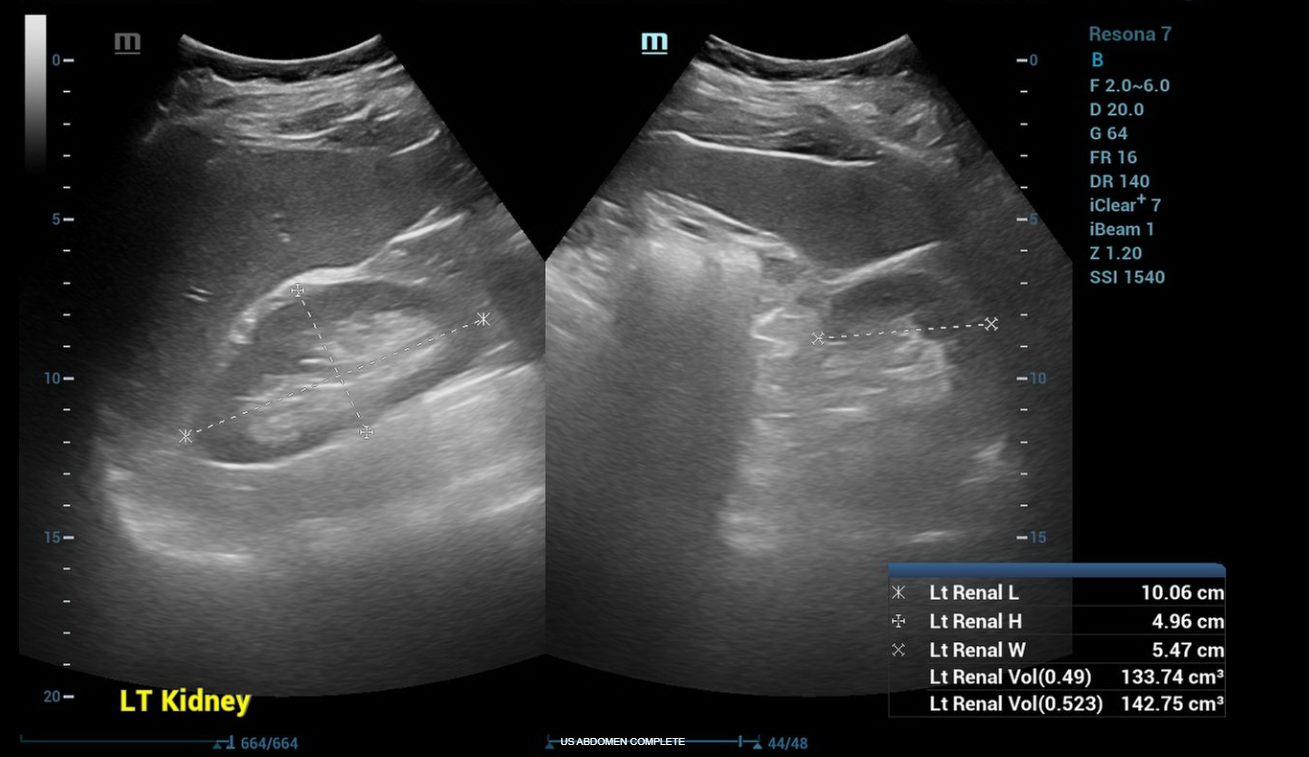 ULTRASOUND ABDOMEN GENERAL