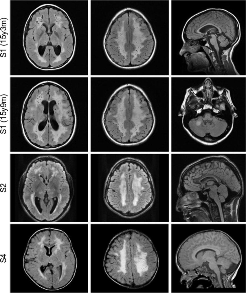 MRI HEAD/BRAIN