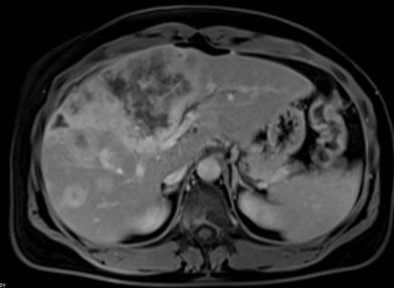 MRI FULL BODY HEAD/NECK/CHEST/ABDOMEN/PELVIS/SPINE