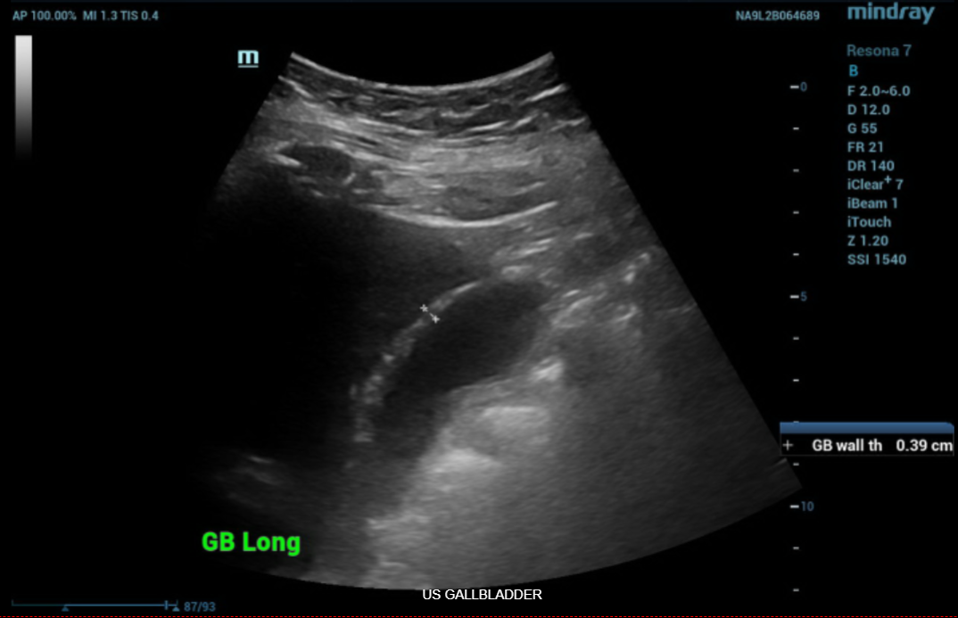 ULTRASOUND GALLBLADDER