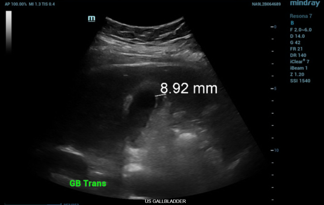 ULTRASOUND GALLBLADDER
