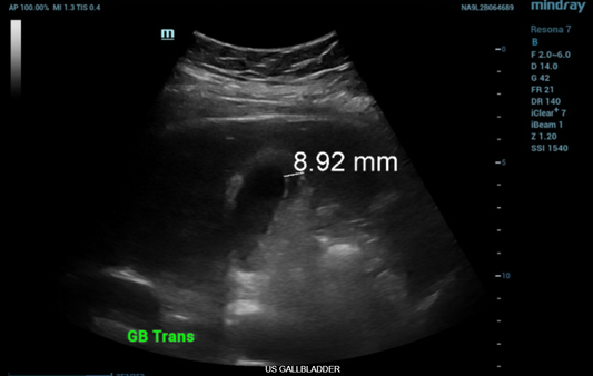 ULTRASOUND GALLBLADDER