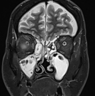 MR ANGIOGRAM HEAD/BRAIN
