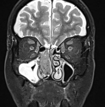 MR ANGIOGRAM HEAD/BRAIN