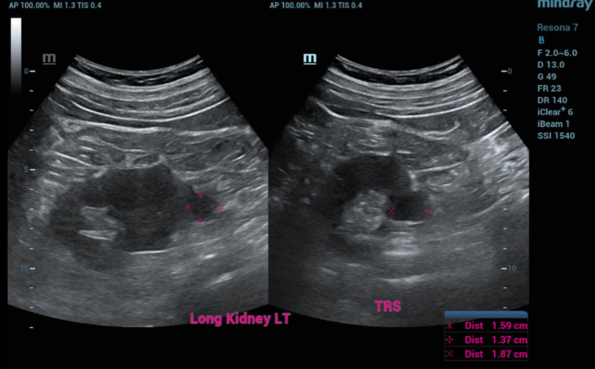 ULTRASOUND KIDNEYS