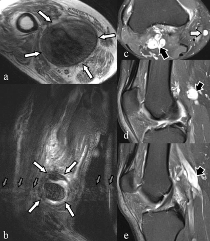 MRI KNEE