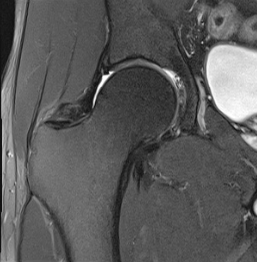 MRI FEMUR