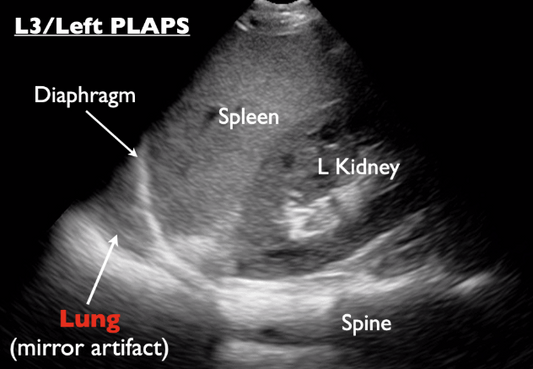 ULTRASOUND PLEURAL SPACE