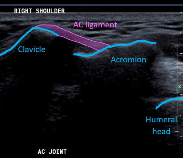 ULTRASOUND SHOULDER