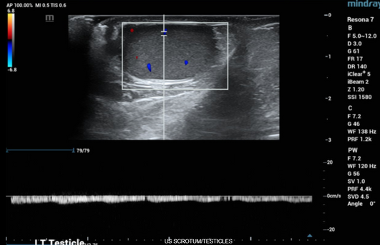 ULTRASOUND TESTICLES