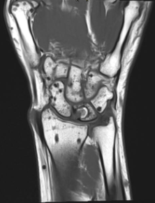 MRI WRIST