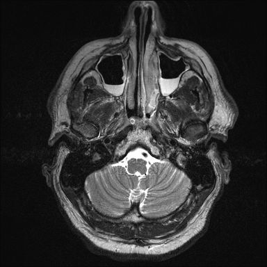 MRI FACE/SINUS