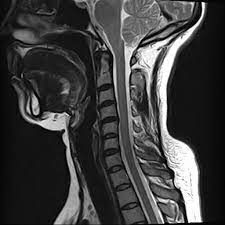 MRI NECK/THYROID