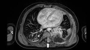 MRI CHEST