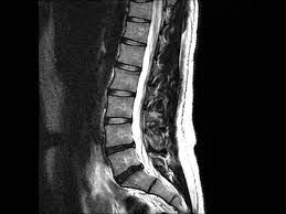 MRI LUMBAR SPINE