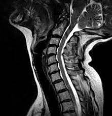 MRI CERVICAL SPINE