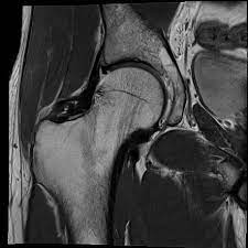 MRI HIP