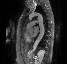 MR ANGIOGRAM CHEST/AORTA