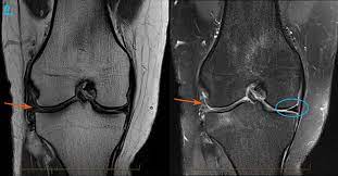 MRI KNEE