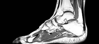 MRI FOOT