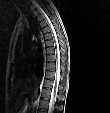 MRI THORACIC SPINE