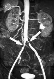 Aorta Iliac Arteries/Pelvis Magnetic Resonance Angiography (MRA)