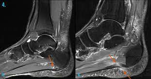 MRI ANKLE