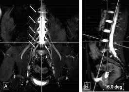 MRI SACRUM/SACRAL NERVE PLEXUS