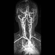 Carotid Arteries/Neck Magnetic Resonance Angiography (MRA)