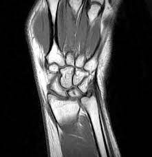 MRI WRIST