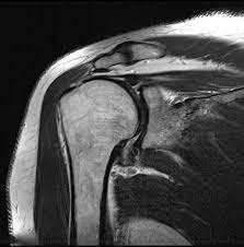 MRI SHOULDER